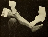 An illustration from Fractures and dislocations, diagnosis and treatment (1915)