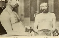 Picture 26 of 481 from Fractures and dislocations, diagnosis and treatment (1915), leaf 64