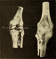 An illustration from Fractures and dislocations, diagnosis and treatment (1915)