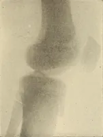 Picture 376 of 481 from Fractures and dislocations, diagnosis and treatment (1915), leaf 650