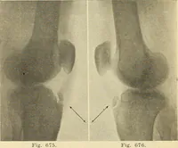 Picture 377 of 481 from Fractures and dislocations, diagnosis and treatment (1915), leaf 651