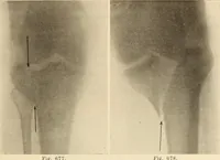 Picture 378 of 481 from Fractures and dislocations, diagnosis and treatment (1915), leaf 652