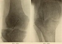 Picture 379 of 481 from Fractures and dislocations, diagnosis and treatment (1915), leaf 652