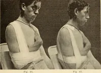 An illustration from Fractures and dislocations, diagnosis and treatment (1915)