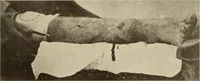 Picture 381 of 481 from Fractures and dislocations, diagnosis and treatment (1915), leaf 668