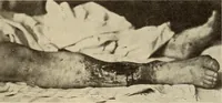 Picture 382 of 481 from Fractures and dislocations, diagnosis and treatment (1915), leaf 670