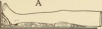 An illustration from Fractures and dislocations, diagnosis and treatment (1915)