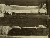 An illustration from Fractures and dislocations, diagnosis and treatment (1915)