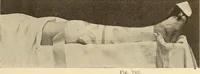 Picture 386 of 481 from Fractures and dislocations, diagnosis and treatment (1915), leaf 674