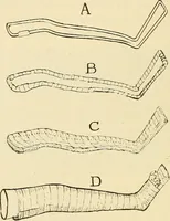 An illustration from Fractures and dislocations, diagnosis and treatment (1915)