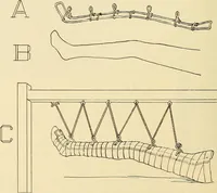 An illustration from Fractures and dislocations, diagnosis and treatment (1915)