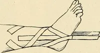 An illustration from Fractures and dislocations, diagnosis and treatment (1915)