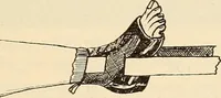An illustration from Fractures and dislocations, diagnosis and treatment (1915)