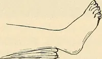 An illustration from Fractures and dislocations, diagnosis and treatment (1915)