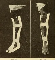Picture 393 of 481 from Fractures and dislocations, diagnosis and treatment (1915), leaf 677