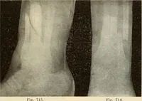 Picture 394 of 481 from Fractures and dislocations, diagnosis and treatment (1915), leaf 680