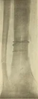 An illustration from Fractures and dislocations, diagnosis and treatment (1915)