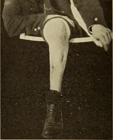 An illustration from Fractures and dislocations, diagnosis and treatment (1915)