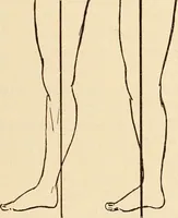 An illustration from Fractures and dislocations, diagnosis and treatment (1915)