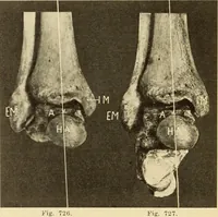 Picture 399 of 481 from Fractures and dislocations, diagnosis and treatment (1915), leaf 689