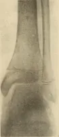 Picture 400 of 481 from Fractures and dislocations, diagnosis and treatment (1915), leaf 690