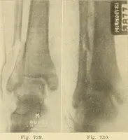 Picture 401 of 481 from Fractures and dislocations, diagnosis and treatment (1915), leaf 691