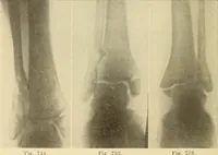 Picture 402 of 481 from Fractures and dislocations, diagnosis and treatment (1915), leaf 691