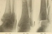 Picture 403 of 481 from Fractures and dislocations, diagnosis and treatment (1915), leaf 692