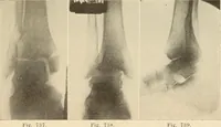 Picture 404 of 481 from Fractures and dislocations, diagnosis and treatment (1915), leaf 692