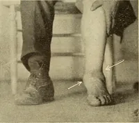 Picture 405 of 481 from Fractures and dislocations, diagnosis and treatment (1915), leaf 693