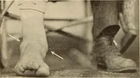 Picture 406 of 481 from Fractures and dislocations, diagnosis and treatment (1915), leaf 694