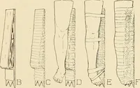 An illustration from Fractures and dislocations, diagnosis and treatment (1915)