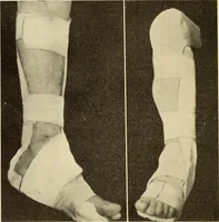 An illustration from Fractures and dislocations, diagnosis and treatment (1915)