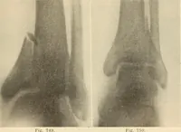 Picture 410 of 481 from Fractures and dislocations, diagnosis and treatment (1915), leaf 704
