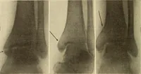 An illustration from Fractures and dislocations, diagnosis and treatment (1915)