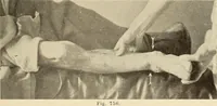 An illustration from Fractures and dislocations, diagnosis and treatment (1915)