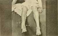 An illustration from Fractures and dislocations, diagnosis and treatment (1915)