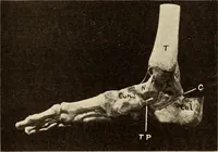 An illustration from Fractures and dislocations, diagnosis and treatment (1915)