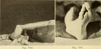 Picture 419 of 481 from Fractures and dislocations, diagnosis and treatment (1915), leaf 717