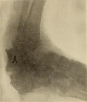 Picture 420 of 481 from Fractures and dislocations, diagnosis and treatment (1915), leaf 722