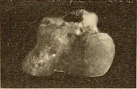 An illustration from Fractures and dislocations, diagnosis and treatment (1915)