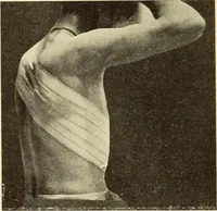 An illustration from Fractures and dislocations, diagnosis and treatment (1915)