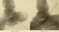 Picture 422 of 481 from Fractures and dislocations, diagnosis and treatment (1915), leaf 733