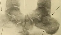 Picture 423 of 481 from Fractures and dislocations, diagnosis and treatment (1915), leaf 733