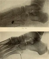 Picture 424 of 481 from Fractures and dislocations, diagnosis and treatment (1915), leaf 744