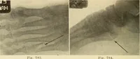 Picture 425 of 481 from Fractures and dislocations, diagnosis and treatment (1915), leaf 745