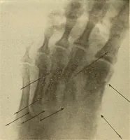 Picture 426 of 481 from Fractures and dislocations, diagnosis and treatment (1915), leaf 745
