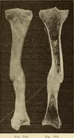 An illustration from Fractures and dislocations, diagnosis and treatment (1915)