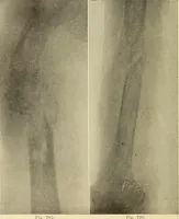 Picture 431 of 481 from Fractures and dislocations, diagnosis and treatment (1915), leaf 757