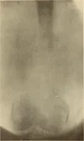 Picture 432 of 481 from Fractures and dislocations, diagnosis and treatment (1915), leaf 758